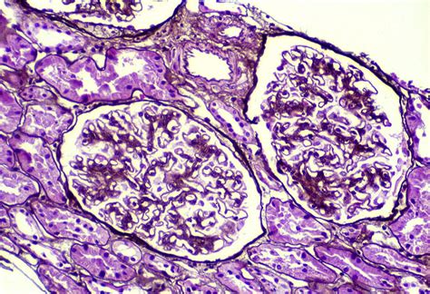 AJKD Atlas of Renal Pathology: Membranous Nephropathy.